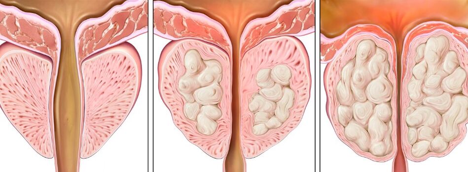 Fase della prostatite